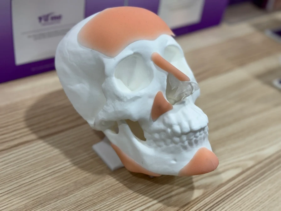 Xu Yingzhe said that 3D printing can help make the prosthetic carving more detailed and fit the bone tissue of the face better during surgery.