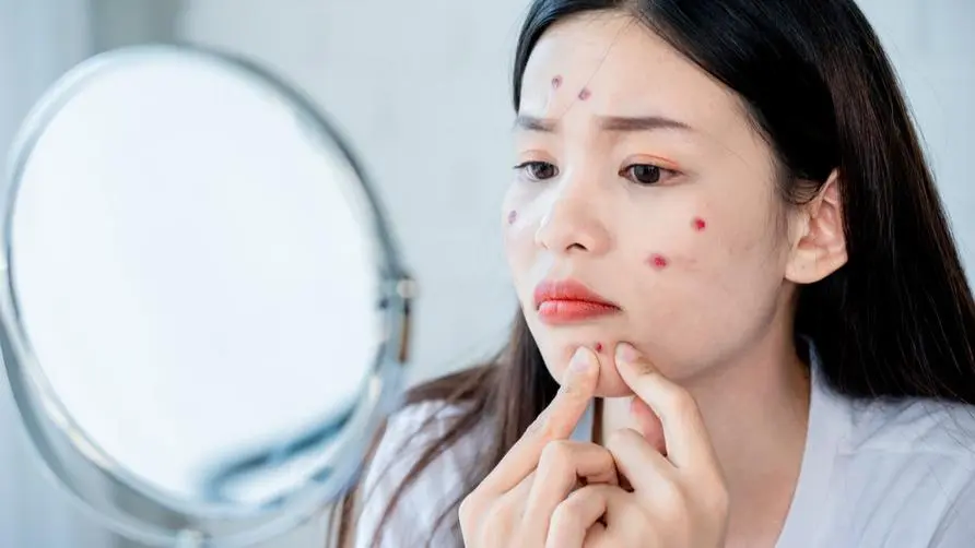 Do you get acne and pimples as soon as winter comes? Dermatologist answers: The "3 bad habits" at the end of the year are the culprits of acne breakouts