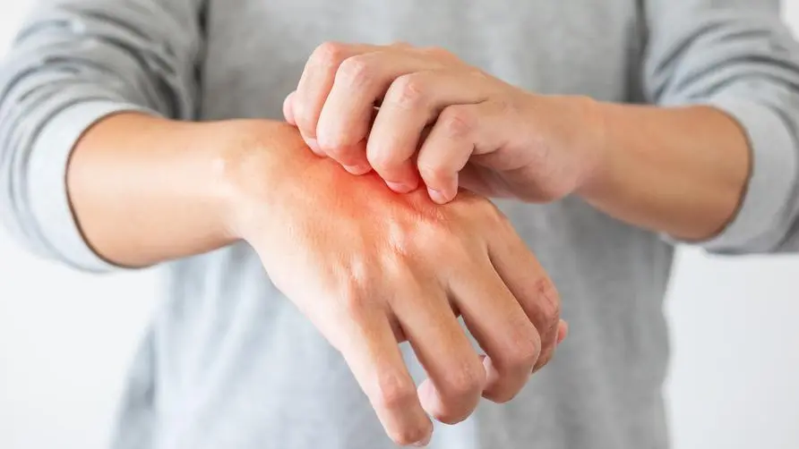 Are you afraid of contagion when shaking hands? He suffered from "atopic dermatitis" and was bullied, and his job search was blocked! Doctor: The earlier the treatment, the better the control effect.