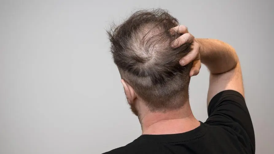 Why do alopecia areata, alopecia areata, and pressure baldness occur? Harvard reveals "7 major causes" of common hair loss