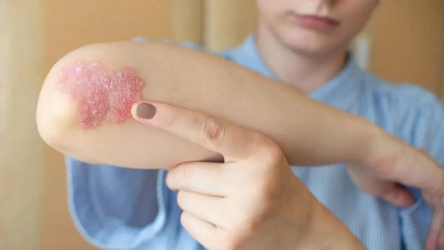 The comorbidity of psoriasis spreads all over the body. Latest guidelines from the Dermatology Association: Toward the goal of "clearing" the lesions