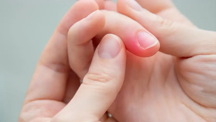 I thought it was just paronychia that won't go away! A doctor's examination found "nail cancer": it was so severe that the finger needed to be amputated