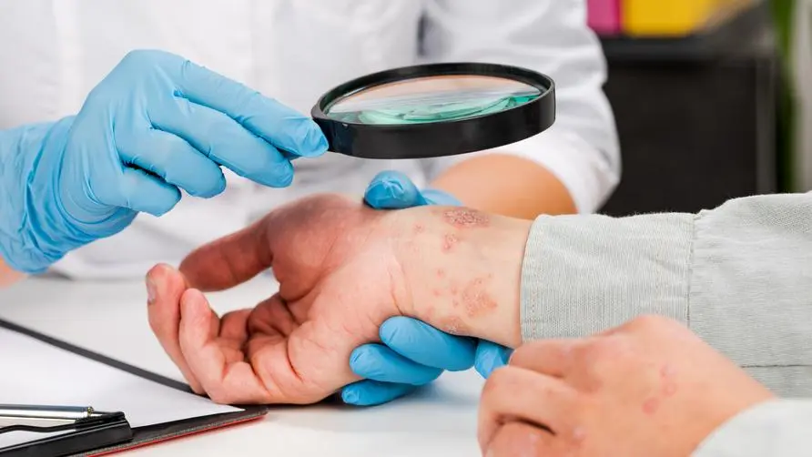 What is psoriasis? Which areas should you pay attention to if there are signs? Doctor: Taking "supplements" indiscriminately affects immunity and may cause a major outbreak