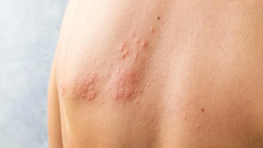 Is a shingles attack more painful than giving birth? Doctors appeal: 10 risk groups do not want to "suffer from skin pain" and get vaccinated quickly!