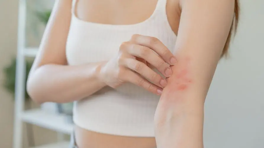 Skin diseases that cannot be cured are caused by "eating the wrong food"? Nutritionist reveals "10 types of diet" that make eczema symptoms worse